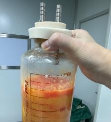 昆明水动力吸脂手术要做多久？